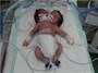 تولد نوزاد دو سر در بیمارستان دزفول
