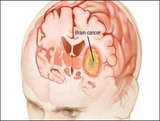 علائم بروز سکته مغزی چیست؟