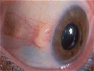 خطرناک‌ترین آسیب چشمی را بشناسید/دلایل اختلالات دردناک بینایی