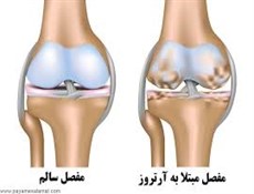 نقش پیاده روی در کاهش آرترز