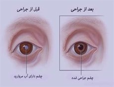 عوامل ابتلا به آب مروارید/درمان بموقع از نابینایی پیشگیری می‌کند