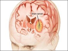 تشخیص سرطان مغز ظرف 30 دقیقه