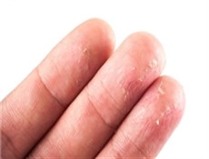 اگزما و چهره پنهان آن