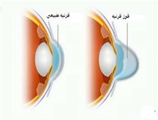 دوبینی و نورگریزی از علائم قوز قرنیه است