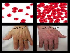 عوارض بالا یا پایین بودن سطح آهن خون