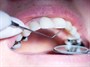 جرم دندان و خونریزی لثه زنگ خطر سلامت دهان و دندان