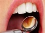 پوسیدگی دندان دومین بیماری شایع در کشورهای در حال توسعه