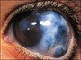 تولید لنزهای تماسی برای درمان یکی از عوامل نابینایی