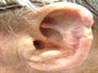 خطر جدی در کمین لاله گوش شما