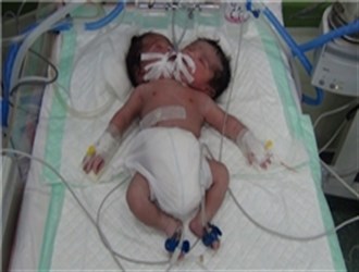 تولد نوزاد دو سر در بیمارستان دزفول