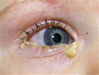 ترشح چشم همراه با آبریزش بینی به آنتی‌بیوتیک نیاز ندارد